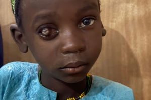 Nijerya Katarakt Ameliyatı